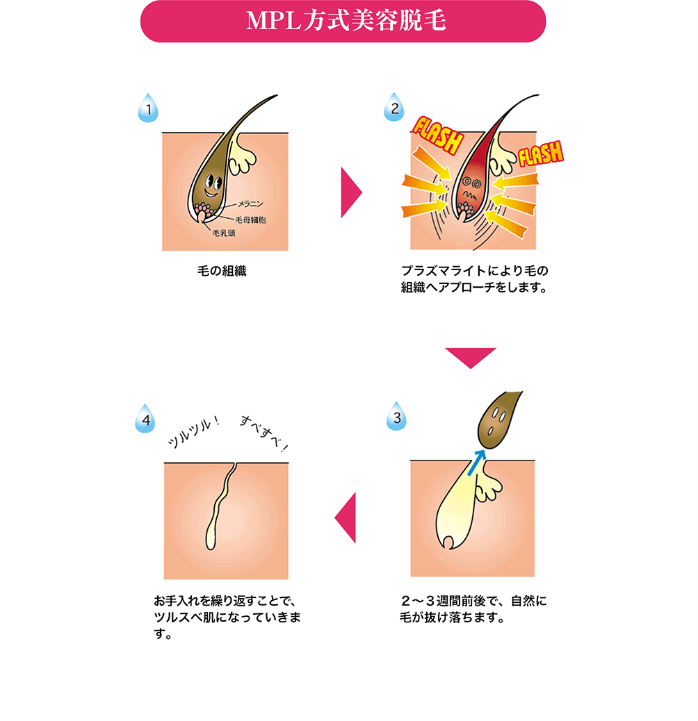 MPL方式美容脱毛